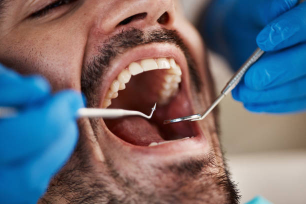 Best Emergency Dental Care for Broken or Chipped Teeth in Cocoa West, FL